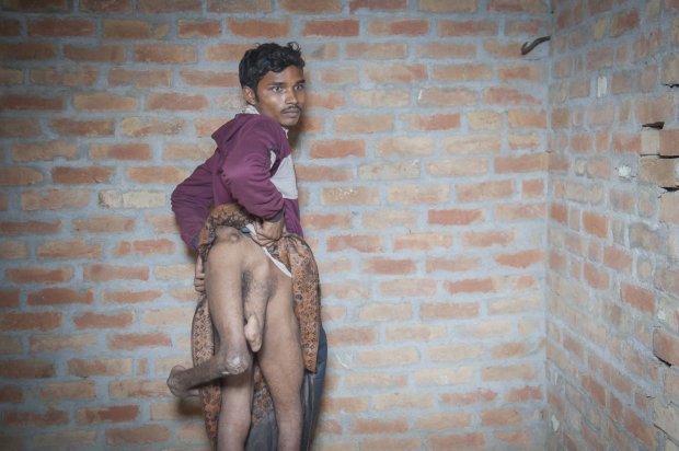 *** EXCLUSIVE - VIDEO AVAILABLE *** FARRUKHABAD, INDIA - DECEMBER 9: Arun Kumar Rajput shows his four legs at his house on December 9, 2015 in Farrukhabad, India. A YOUNG man with FOUR legs appealed to doctors to amputate his two extra limbs. Arun Kumar, 22, was born with two extra legs growing from his lower back - one underdeveloped and the other permanently bent at the knee. After living for 15 years without any kind of treatment, Arun, from Uttar Pradesh, India, appealed through social media for medical help to remove his extra legs. A team of specialists at Fortis Hospital in Delhi responded to Arunís plea for help and organised a series of tests to find out how the legs are attached and if he can be treated. **CONDITION OF USAGE: The following plug must be used in print and/or online: Arun's story appears in Body Bizarre, Thursday November 3, 10pm, on TLCî credit: TLC/ Barcroft Productions** PHOTOGRAPH BY Arkaprava Ghosh / Barcroft Images London-T:+44 207 033 1031 E:hello@barcroftmedia.com New York-T:+1 212 796 2458 E:hello@barcroftusa.com New Delhi-T:+91 11 4053 2429 E:hello@barcroftindia.com www.barcroftimages.com