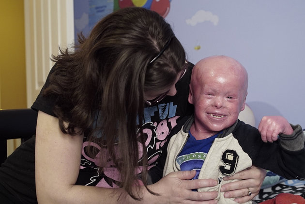 *** EXCLUSIVE - VIDEO AVAILABLE *** GOSHEN, CONNECTICUT - MAY 07: Five-year-old Evan giggles as he is cuddled by mum De De, on May 07, 2016, in Goshen, Conneciticut. FIVE-YEAR-OLD Evan Fascianos condition causes his skin to grow at ten times the normal rate, leaving him at risk of life-threatening infection. Evan, from Goshen, Connecticut, was born with Harlequin Ichthyosis, a genetic disorder that leaves him with scales across his entire body. Suffering from the severest form of the disease, Evan is at constant risk of infection - requiring him to have two baths a day so 33-year-old mum De De can scrub off the excess skin. Currently there is no cure for Harlequin Ichthyosis, but despite his condition Evan remains a lively, happy child, who is incredibly popular at school and loves to play with his younger brother Cenzo. For more information on Harlequin Ichthyosis and other severe skin conditions, please visit www.firstskinfoundation.org PHOTOGRAPH BY Steven Schloss / Barcroft Images London-T:+44 207 033 1031 E:hello@barcroftmedia.com New York-T:+1 212 796 2458 E:hello@barcroftusa.com New Delhi-T:+91 11 4053 2429 E:hello@barcroftindia.com www.barcroftmedia.com