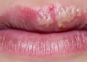 remediu herpes