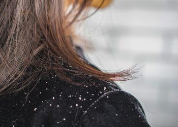 closeup woman hair with dandruff falling on shoulders