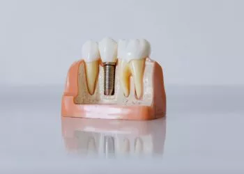 implanturi dentare