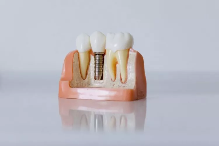 implanturi dentare