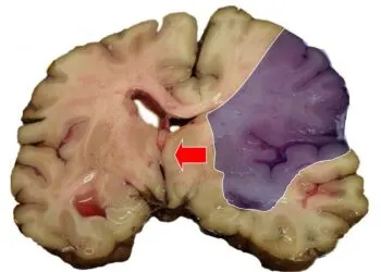 Accidente vasculare cerebrale, tot mai frecvente la adulți sub 55 de ani