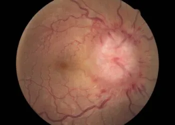 Cercetători identifică o regiune cerebrală care declanșează hipertensiunea arterială