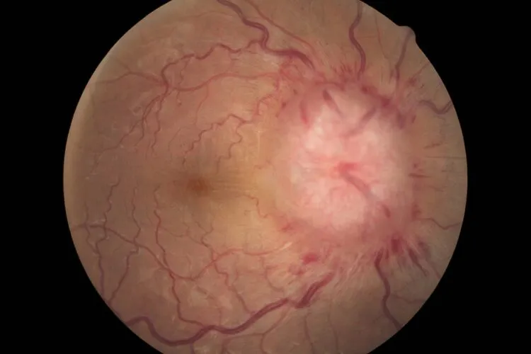Cercetători identifică o regiune cerebrală care declanșează hipertensiunea arterială